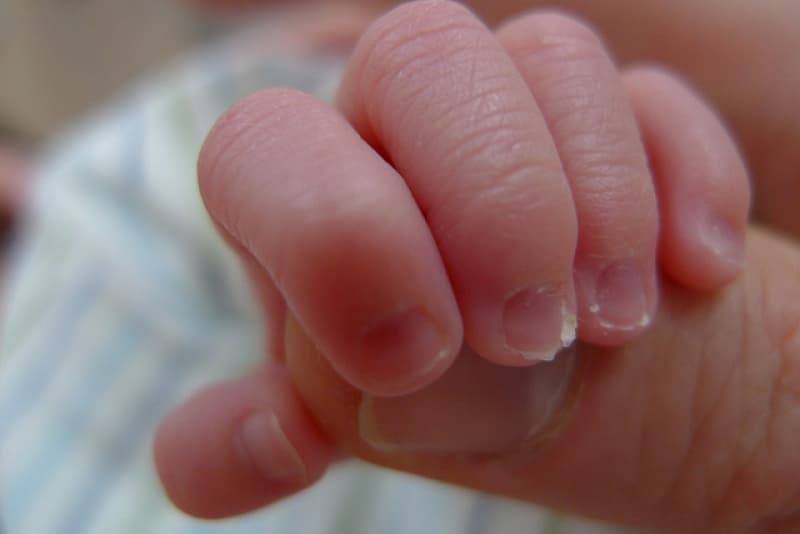 Balancing hope for extremely premature babies