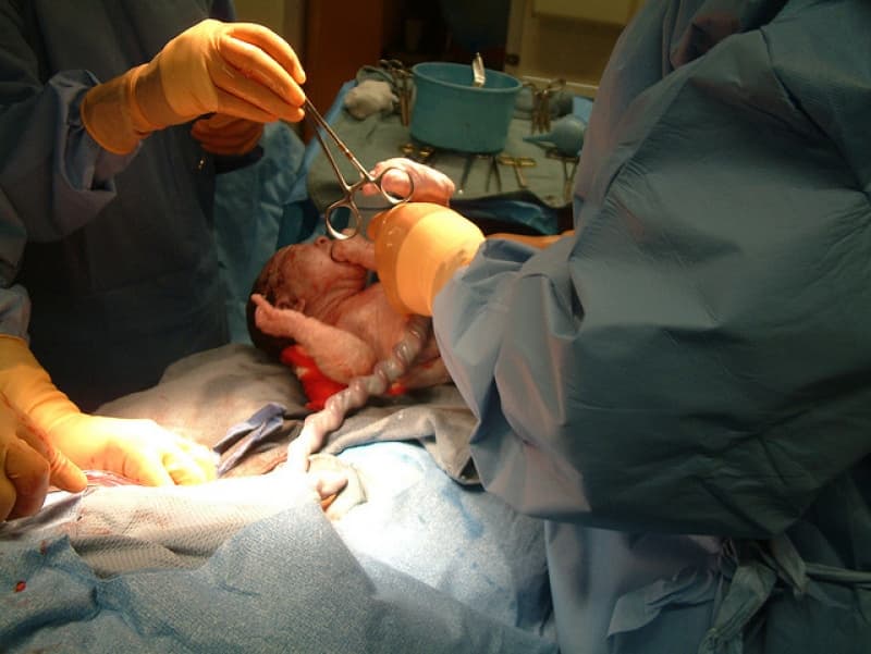 Are c-section targets “too low”?