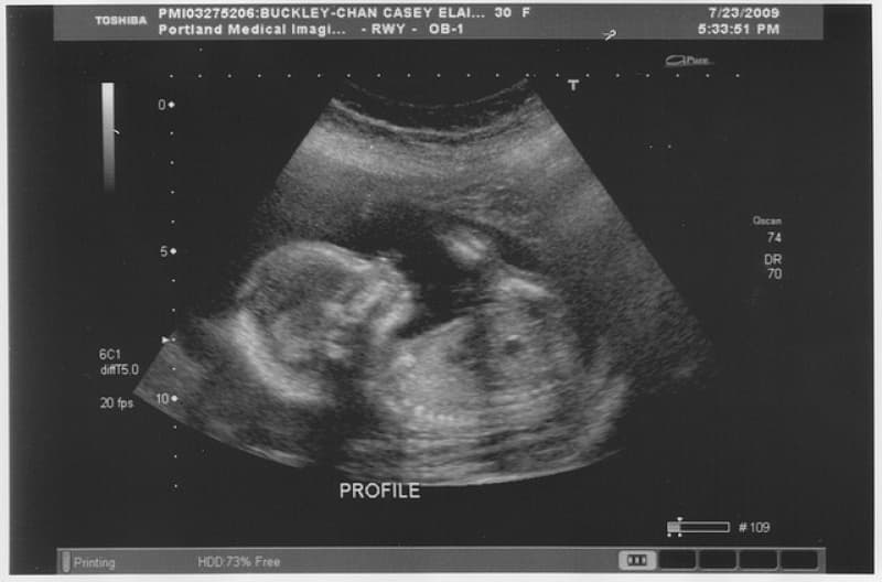 New ultrasound guidelines give more certainty