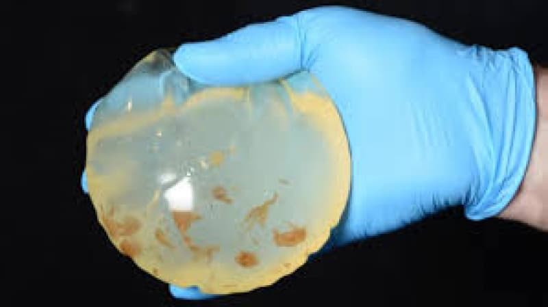 Bacteria in Breast Implants