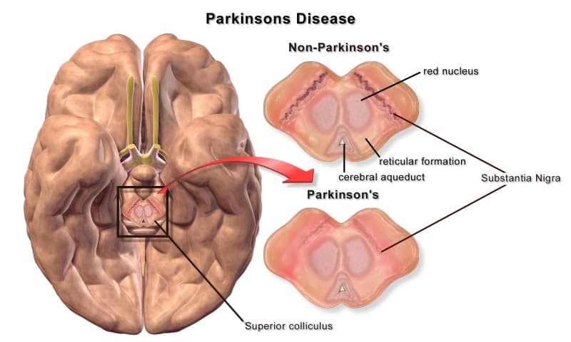 Activin A: Latest developments in Parkinson’s disease research