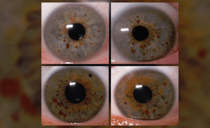 Eye Pigmentation is Linked to a Risk Of Melanoma