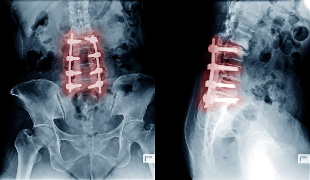 Spinal Fusion Surgery: why it might not fix your lower back pain