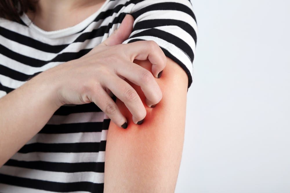 Why are more and more Aussies being diagnosed with Eczema?