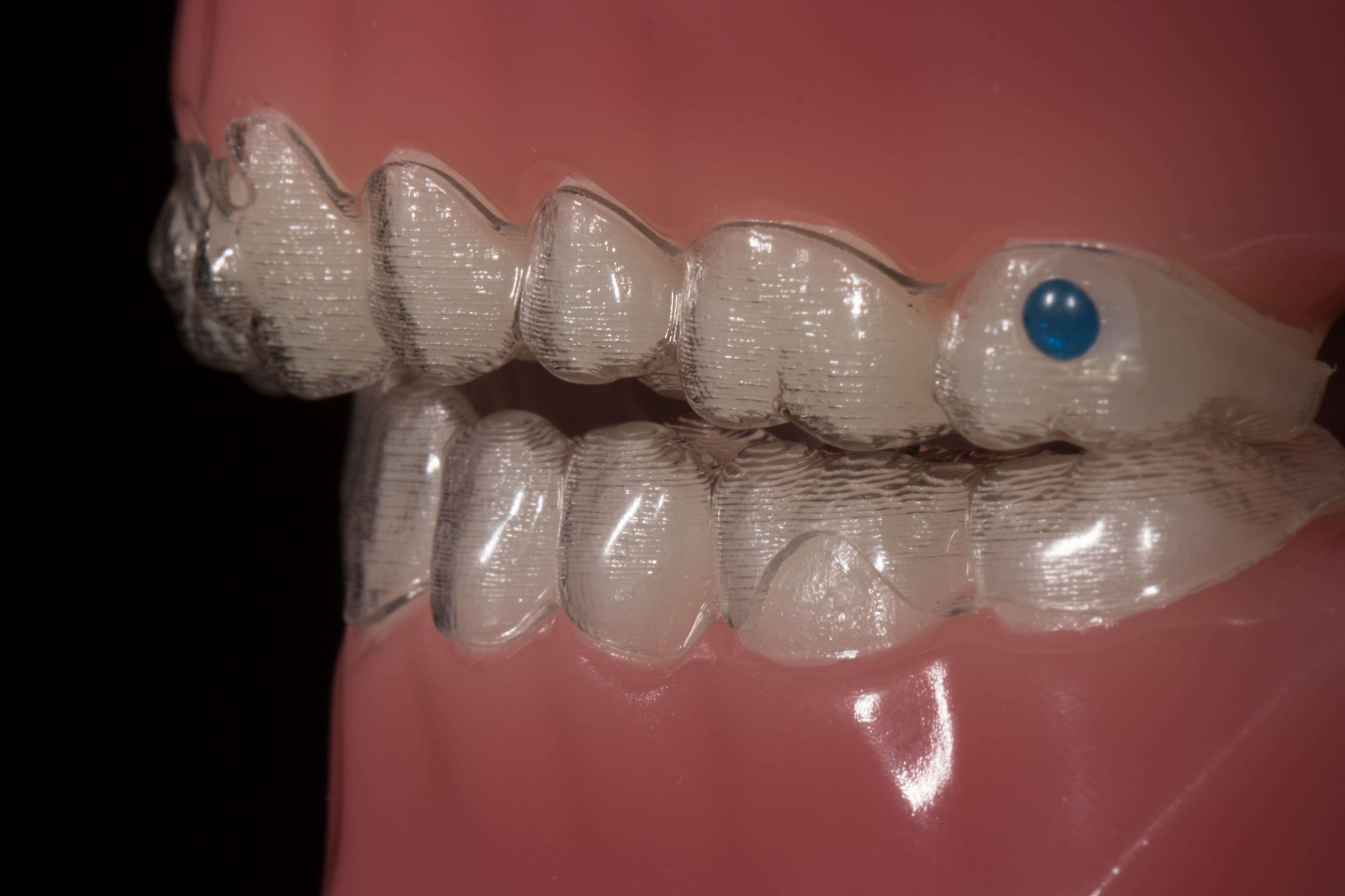 Dentists Issue Warning Against DIY Home Teeth Straitening Kits