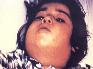 New Diphtheria cases