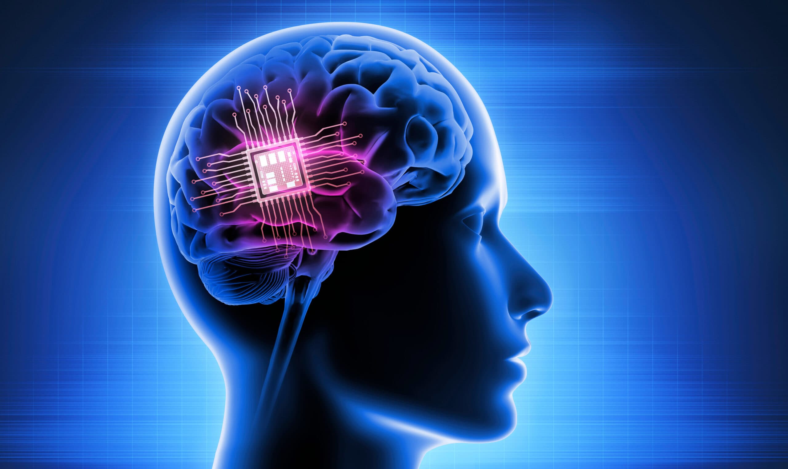 MND – Elon Musk’s Neuralink implants first brain chip