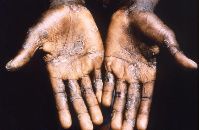 What do we know about Mpox and the current Outbreak?